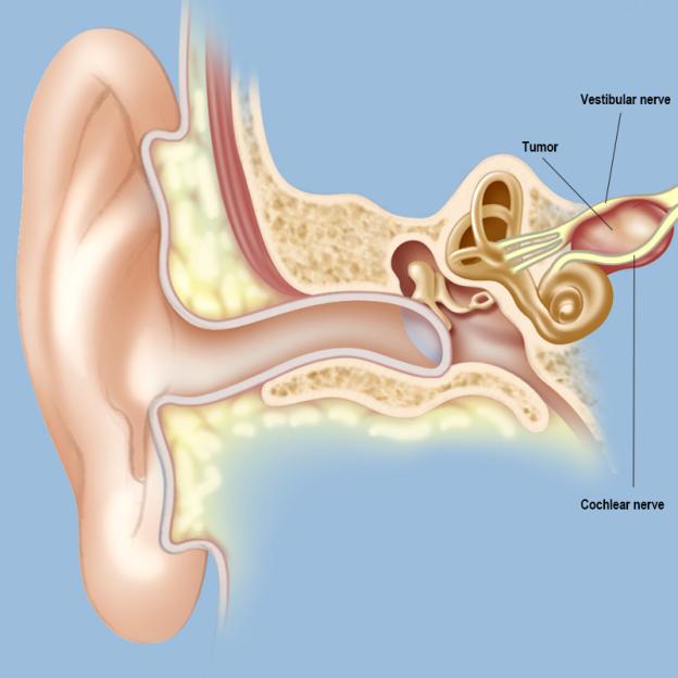 Illustration of a cross-section of the human ear, showing a tumor on the vestibular nerve.