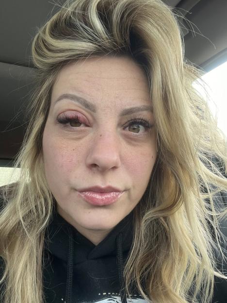 A woman with blond hair looks at the camera with her right eye swollen shut.