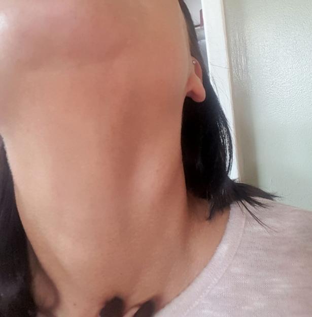 Close-up of a lump in a woman's neck before cancer diagnosis.