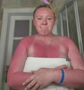 Woman with severe sunburn after skipping sunscreen in Turkey despite cloudy weather.