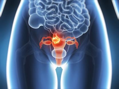 Illustration of uterine cancer.