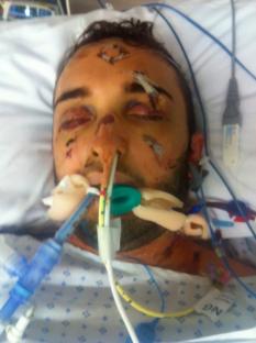 Man in hospital bed with severe facial injuries.