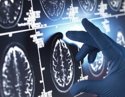 Gloved hand pointing at brain scan.