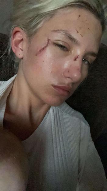 Close-up of a woman's face showing facial injuries.