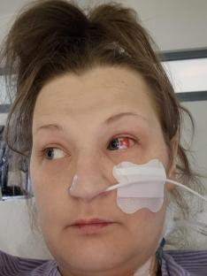 Close-up of a woman's face showing burst blood vessels in her eye and a bandage on her cheek.