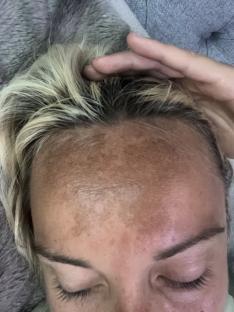Close-up of a woman's forehead showing dark marks.