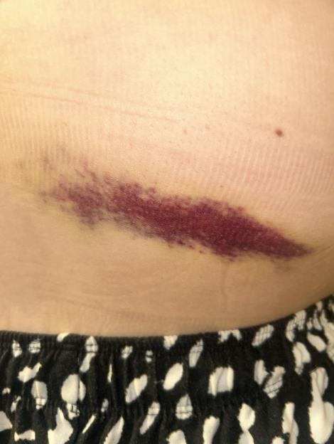 Pic from Kennedy News & Media (Pictured: THE BRUISING ON 21-YEAR-OLD JESSICA FOSTER'S BACK AFTER SLIPPING OVER IN 'OLD' CROCS.) A student is warning people not to wear 'old' Crocs - after slipping at a waterpark and being rushed to hospital with cracked ribs and internal bruising. Jessica Foster, from Grimsby in Lincolnshire, visited a waterpark with her partner Chad Munslow, 26, and his family, on July 19th to enjoy a day playing on the inflatables. But when the 21-year-old left the changing rooms in her size five white Crocs she says she slipped on wet grass, twisting her left foot and smashing her lower back into a steel step.DISCLAIMER: While Kennedy News and Media uses its best endeavours to establish the copyright and authenticity of all pictures supplied, it accepts no liability for any damage, loss or legal action caused by the use of images supplied and the publication of images is solely at your discretion. SEE KENNEDY NEWS COPY - 0161 697 4266