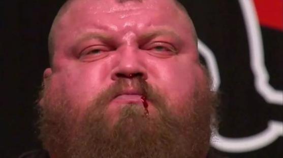 Close-up of Eddie Hall with a bloody nose.