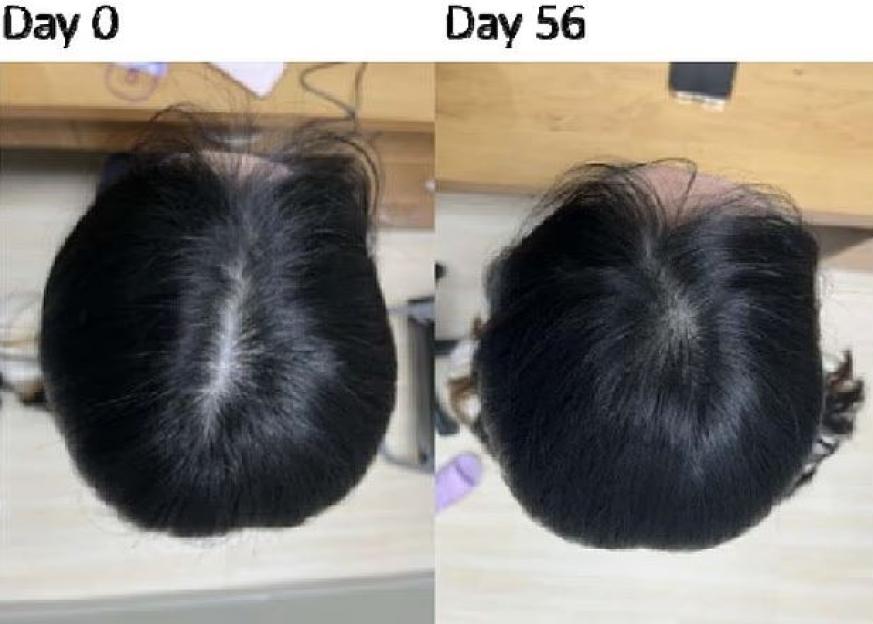 Collage of two images showing hair loss before and after treatment, with hair on day 56 appearing fuller and thicker than on day 0.