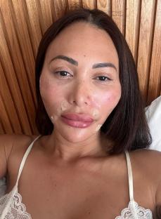 Woman with small bandages on her face after cosmetic procedures.