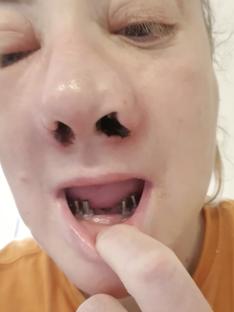 Close-up of a woman's face showing damage from botched dental implants.