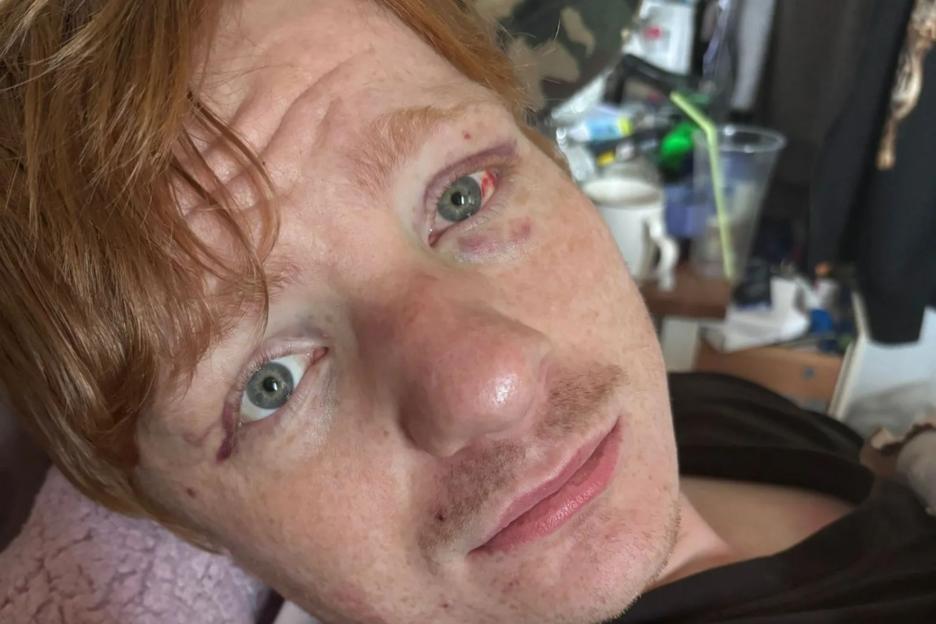 Ed Sheeran lookalike feared he was going to be killed after thugs targeted him for looking like singer in brutal attack
