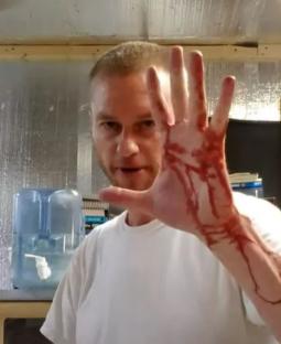 Person showing hand with red markings, illustrating antibodies protecting against venom.
