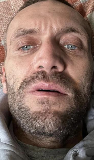 Close-up of a man's face showing the effects of a cocaine addiction.