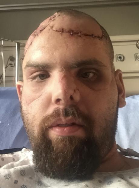 Man with severe facial injuries from a grizzly bear attack.