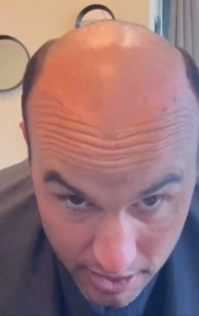 A man with a receding hairline and prominent forehead wrinkles stares intently at the camera.