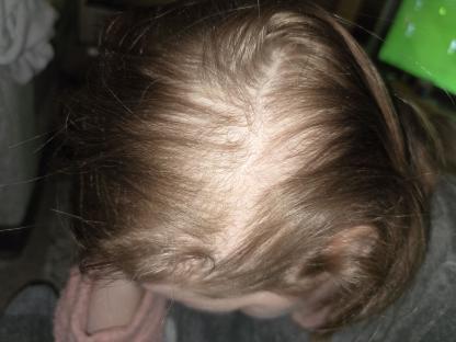 Close-up of a woman's scalp showing hair loss.