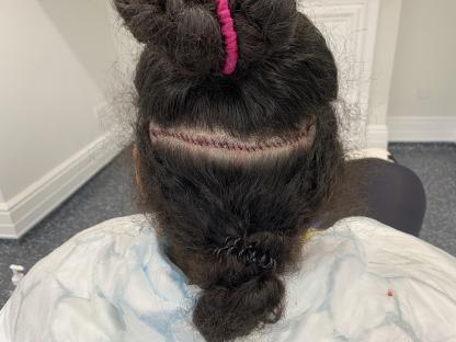 Person's head with a surgical incision visible through their hair.