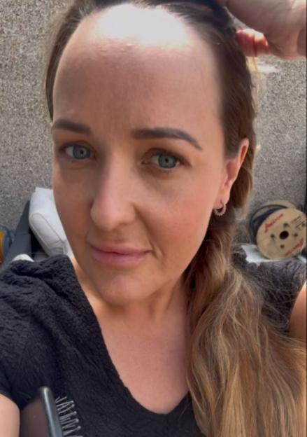 Before and after photos of a woman's forehead reduction.