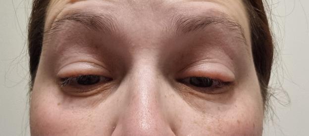 Close-up of a woman's face showing swollen eyes, possibly due to an allergic reaction.
