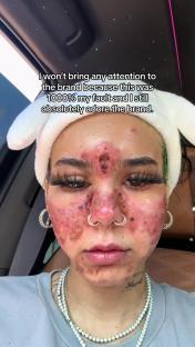 Close-up of a person's face with severe acne.