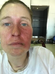 Close-up photo of a woman's face showing redness and swelling, possibly due to a medical condition.