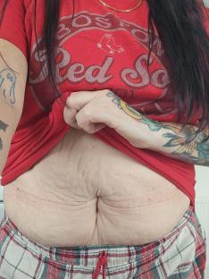 Person's abdomen showing stretch marks.