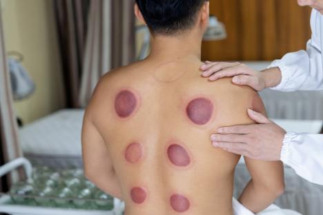 Asian male patient receiving cupping therapy treatment at chinese medicine shop.Traditional Chinese Medicine Treatment.Alternative Medicine,Alternative Therapy.