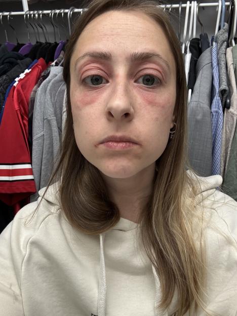 Woman with red, swollen eyes and face.