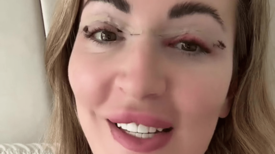 I did a 24hr trip to Amsterdam for ‘saggy eyelid’ surgery – the results are insane, and it was so cheap