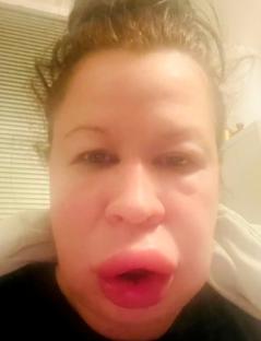 Close-up photo of Joanna Hayes showing a reaction to mold in her flat.