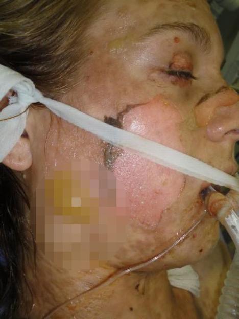 Woman with severe facial burns from Stevens-Johnson syndrome.