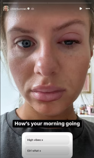 Close-up of Chloe Burrows with a swollen eye.