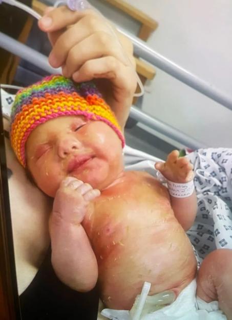 Newborn Caiden with ichthyosis in a rainbow knit hat.