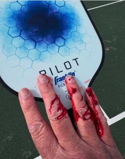 Bloody hand on pickleball paddle.