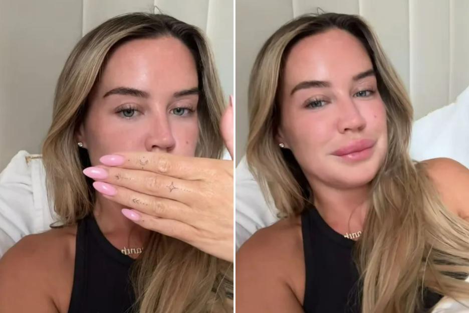 Love Island’s Sam Kenny sparks concern with VERY swollen lips after reaction to getting her pout dissolved