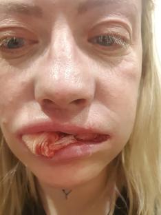 Close-up of a woman's mouth with a bloody gauze pad.