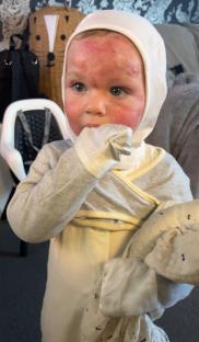 Toddler with severe eczema.