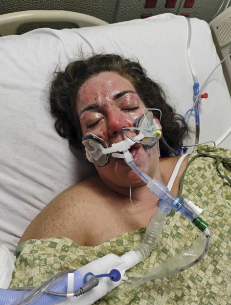 Stephanie Bell in a hospital bed with burns on her face and an intubation tube in her mouth.