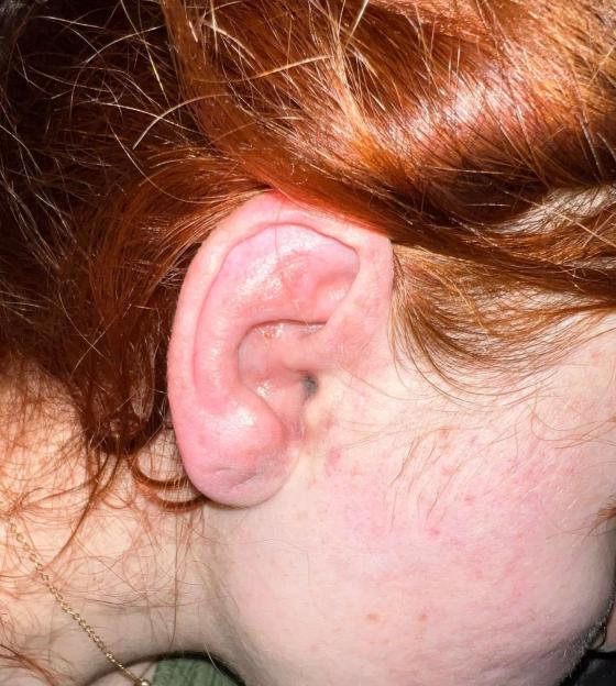 Close-up of a woman's swollen and blistered ear.