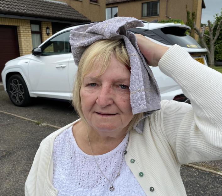 Woman with a head wound after being attacked by a seagull.