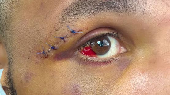 Chris Eubank Jr shows off horror bloodied eye on set of hit Netflix show after almost dying in Conor Benn fight