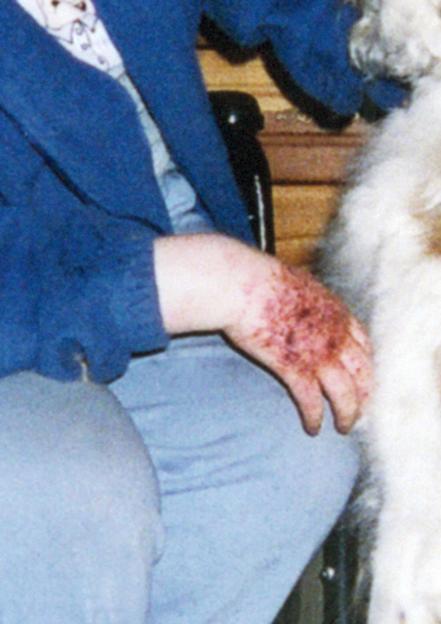 Injuries sustained by a foster child of Eunice Spry.
