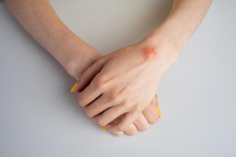 Close-up of a ganglion cyst on a woman's wrist.