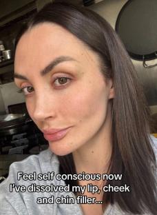 Close-up of a woman's face after dissolving lip, cheek, and chin filler.