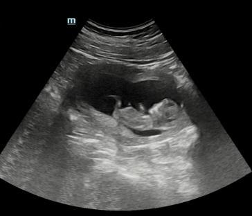 Ultrasound image of a fetus.