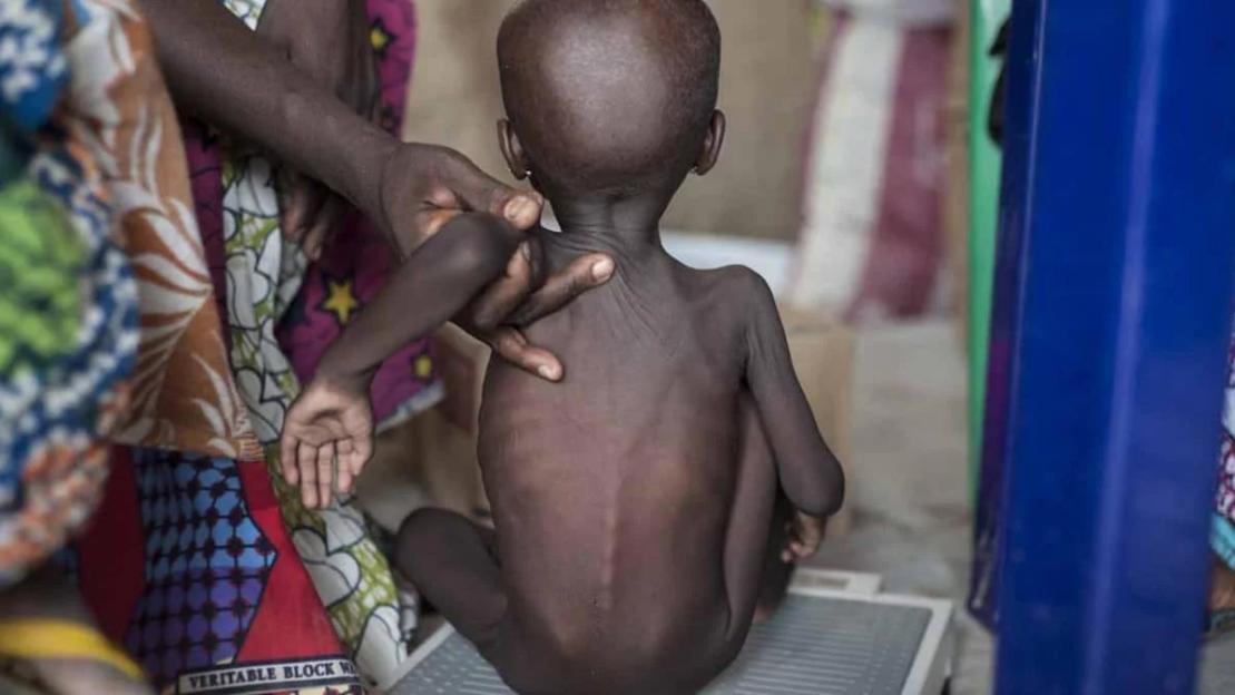 UNICEF decries malnutrition in Plateau, Bauchi, urges unity for survival of children