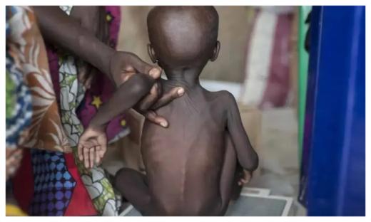 Nigeria has highest burden of malnourished children in Africa – UNICEF