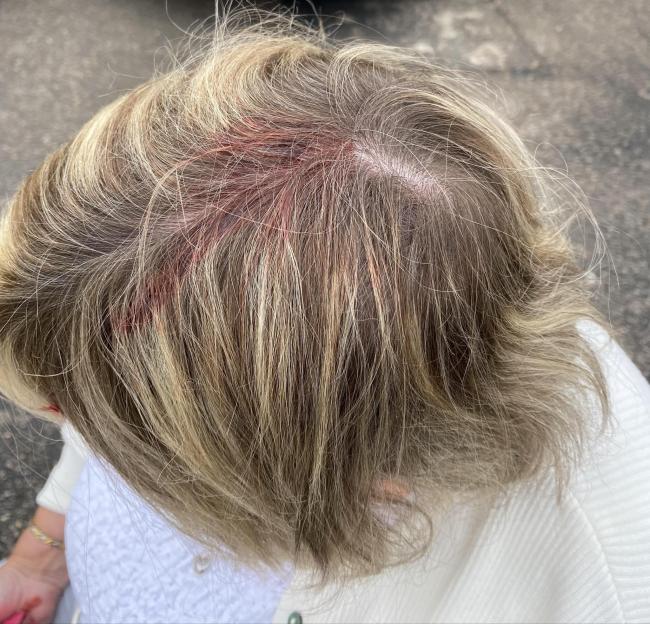 Woman's head wound from seagull attack.