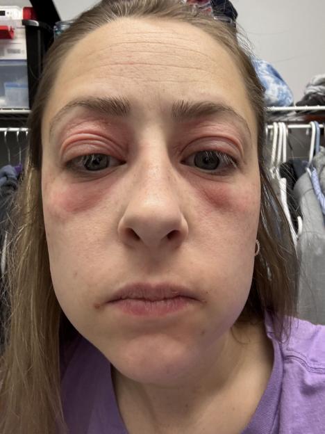 Close-up of a woman's face showing red, swollen eyes and cheeks.